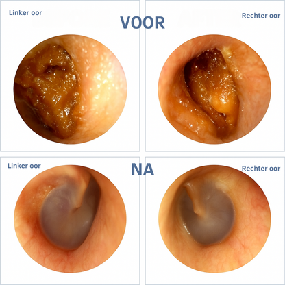 ClearEar™ I Verwijdert oorsmeer veilig en met volledige precisie